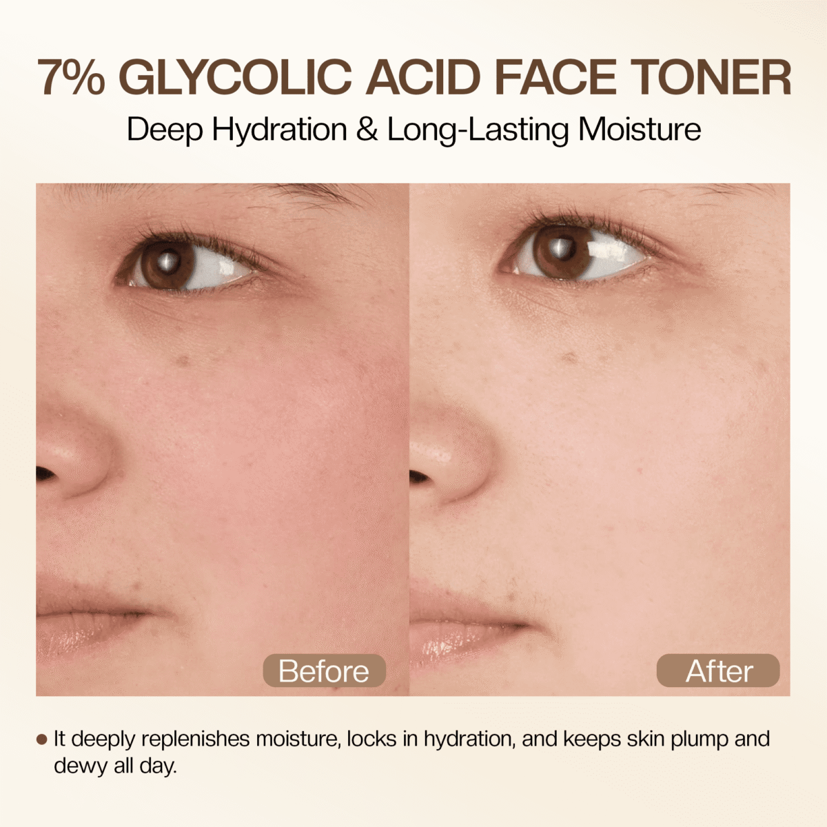 Glycolic Acid Toner: 240ml Glycolic Acid 7% Exfoliating Toner Toning Solution Which Soothes and Hydrates Skin